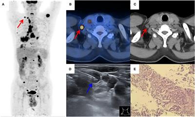 Performance of Ultrasound-Guided Core Biopsy Driven by FDG-avid Supraclavicular Lymph Nodes in Patients With Suspected Lung Cancer